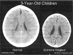 hersenscan verwaarloosde kinderen